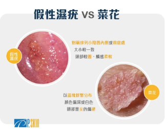 玩偶姐姐有尖锐湿疣？_黑料正能量